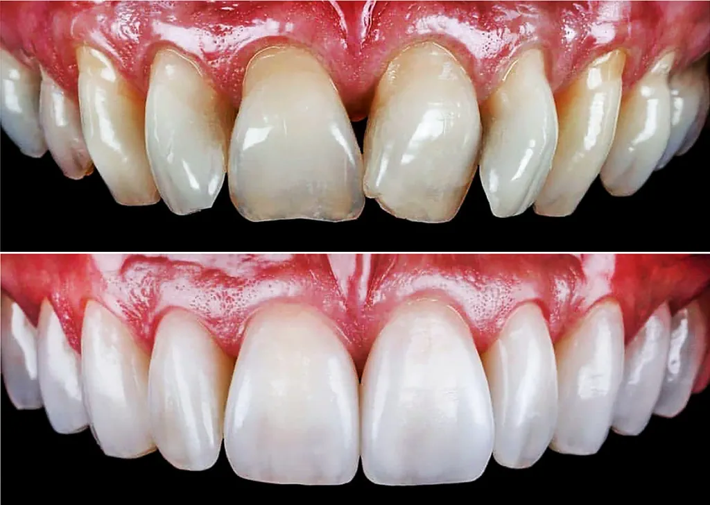 Porcelain Crowns – Why so Popular?